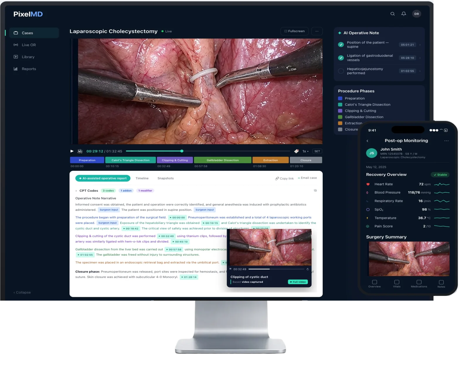 PixelMD surgery suite on a monitor and phone — AI operative note, procedure phases timeline and post-op monitoring